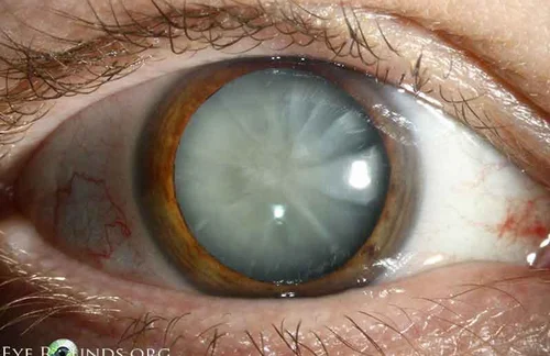 Cataract Surgery