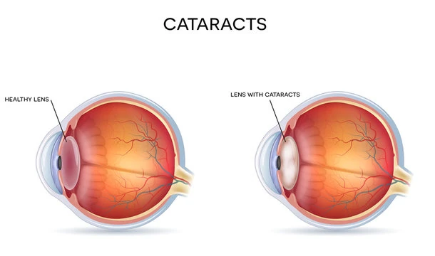 Comparison between healthy lens and lens with cataracts in human eye
